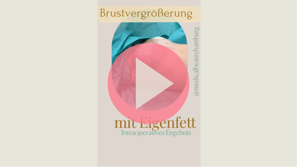 YouTube Video Platzhalter Intraoperatives Ergebnis einer Brustvergrößerung mit Eigenfett