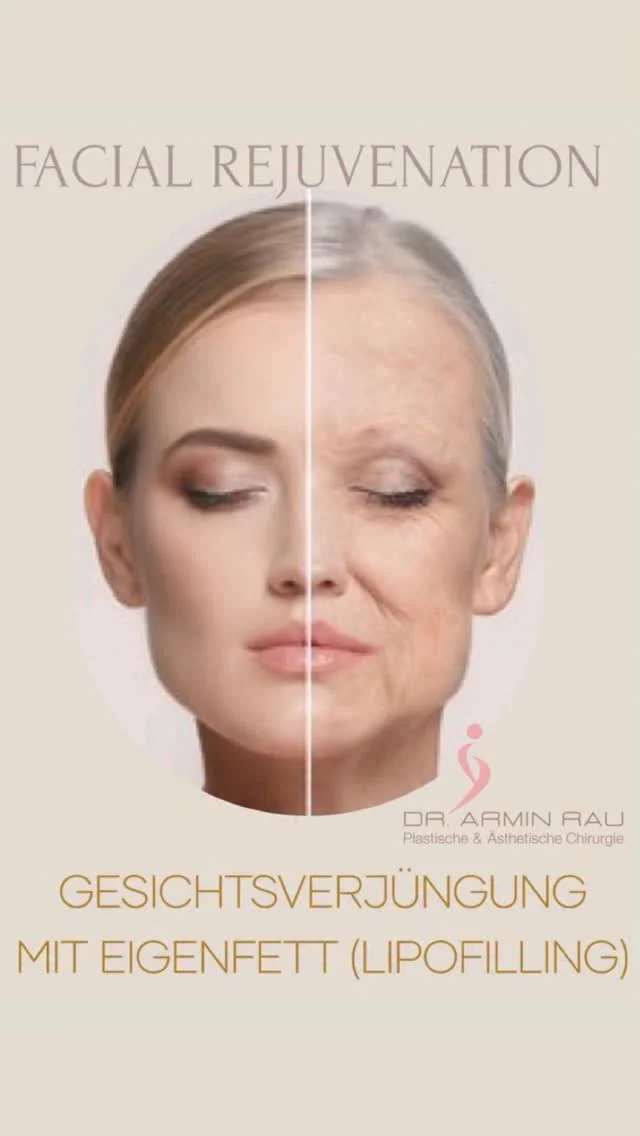 Reverse Aging mit Eigenfett - geht das überhaupt?
Ja! Die Umkehrung der Hautalterung ist mit Lipofilling möglich.
Die in den Fettzellen enthaltenen Stammzellen regenerieren die Haut, gleichen den alterungsbedingten Volumenverlust aus und verjüngen durch die Elastin- und Kollagenneubildung das das Erscheinungsbild der Haut.
Da es sich um körpereigenes Gewebe handelt, ist das Risiko von allergischen oder Abwehrreaktionen minimiert.
Durch das dauerhafte Einheilen eines hohen Anteils des Fettgewebes sind die Ergebnisse lang anhaltend.
Sogar feine Fältchen wie im Lippen- und Unterlidbereich können mit Nanofett behandelt werden und zu einer Glättung der Haut führen.
Zudem wird das jugendliche „V“ durch das Einbringen des Volumens von der Stirn über Schläfen, Wangen, Tränenrinnen, Nasolabial- und Marionettenfalten bis zum Kinn wieder geformt.
Bei „stimulierenden“ Behandlungen, wie Laser, glättet der Lichtschaden zunächst so wie beim Sonnenbrand die Haut, führt aber im weiteren Verlauf zu einer schnelleren Hautalterung. Die regenerativen Maßnahmen wie Lipofilling hingegen, verlangsamen den weiteren Alterungsprozess sogar.
Wenn Ihr mehr zu diesem Thema wissen möchtet, berate ich Euch gerne persönlich. Einen Termin für eine Beratung könnt Ihr über den online Terminkalender vereinbaren oder telefonisch Mo-Fr 10-18h unter 040 4606 3344
Herzlichst, Euer Dr. Armin Rau

#drarminrau #medicalbeautyhamburg #eppendorf #plastischerchirurg #plastischechirurgiehamburg #lidstraffung #schönheitschirurgie #hamburg #oberlidstraffung #facelift #lipofilling