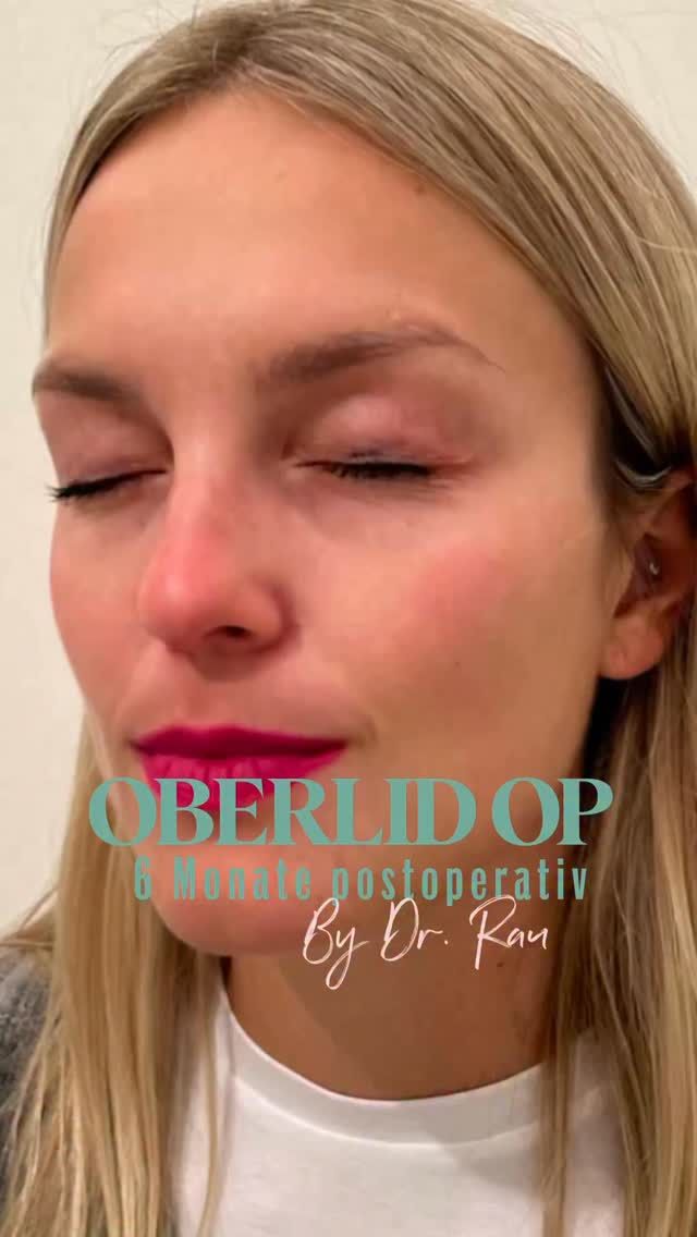 6 Monate nach Oberlidstraffung - eine superzufriedene Patientin 

Unsere Patientin strahlt - und das ganz ohne müde Augen!

Sechs Monate nach Ihrer Oberlidstraffung beidseits zeigt sich ein natürlich-frisches Ergebnis, das perfekt zu ihr passt.

Macht auch Ihr gerne einen Termin für eine Beratung telefonisch Mo-Fr 10-18h unter

040 4606 3344

Euer Dr. Armin Rau

#plastischerchirurg #drarminrau #medicalbeautyhamburg #lidstraffung #hamburg #oberlidstraffung #schönheitschirurgie #eppendorf
