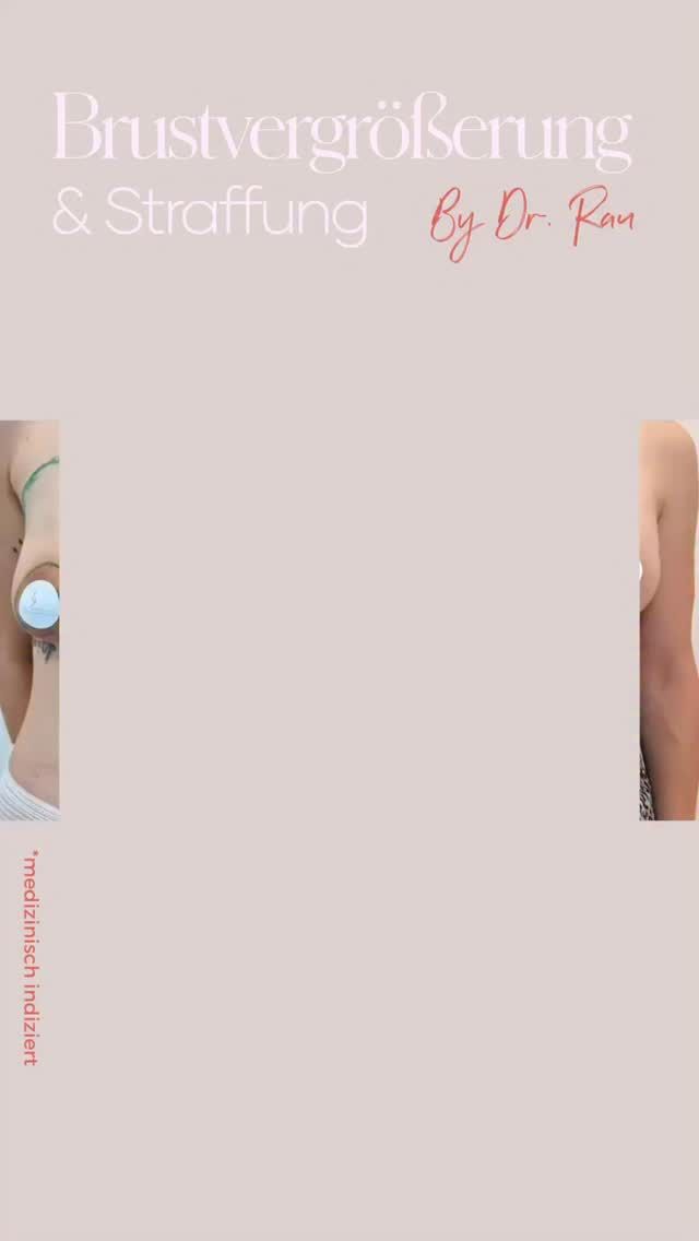 Selbstbewusstsein zurückgewinnen - dank individueller Brustchirurgie *medizinische Indikation 
Unsere Patientin litt unter einer erworbenen Brustasymmetrie infolge einer Involutionsatrophie - einer Rückbildung des Brustgewebes nach Schwangerschaft & Stillzeit.
Durch eine Bruststraffung in Kombination mit einer Brustvergrößerung habe ich nicht nur die Asymmetrie ausgeglichen, sondern auch die natürliche Form und Fülle der Brust harmonisch betont.
Das Ergebnis ist ein wohlgeformtes Dekolleté - und vor allem eine glückliche Patientin, die sich endlich wieder rundum wohl in ihrem Körper fühlt.
Jede Frau und jede Brust ist einzigartig - deshalb plane ich jeden Eingriff individuell angepasst, medizinisch fundiert und mit viel Feingefühl.
Einen Termin für eine Beratung könnt Ihr über meinen online Terminkalender vereinbaren oder telefonisch Mo-Fr 10-18h unter 040 4606 3344
#Bruststraffung #Brustvergrößerung #Brustasymmetrie #PlastischeChirurgie #ÄsthetischeChirurgie #Selbstbewusstsein #Involutionsatrophie #MedicalAesthetics #HappyPatient #BodyConfidence #drarminrau