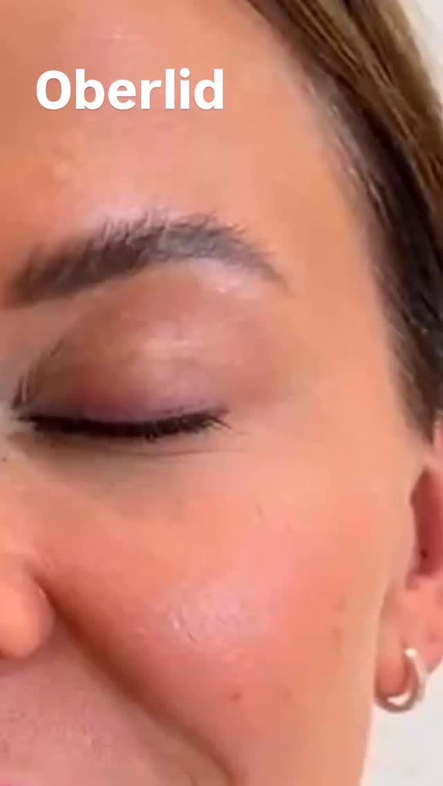 Oberlidstraffung by Dr. Rau ✨

Schmerzfreie Behandlung - 100% zufriedene Patienten - super schnelle Erholung (ca. 1 Woche) - sehr wenig Schwellung - fast immer ohne Bluterguss - wacher Blick - schönes Spiegelbild - positive Komplimente 

Einen Termin für eine Beratung könnt Ihr über den online Terminkalender vereinbaren oder telefonisch Mo-Fr 10-18h unter 040 4606 3344
Euer Dr. Armin Rau

#drarminrau #schönheitschirurgie #lidstraffung #oberlidstraffung #eppendorf #medicalbeautyhamburg #hamburg