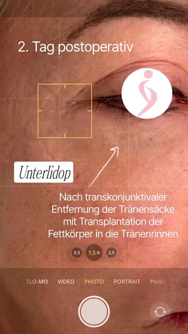 Tränensäcke effektiv behandeln - mit transkgajunktivaler Fettkörperentfernung

Hier seht ihr das Ergebnis meiner Patientin am 2. Tag postoperativ ✨

Tränensäcke entstehen oft durch das Vorwölben von Fettkörper im Unterlidbereich. Diese Fettpolster können mit zunehmendem Alter oder aufgrund genetischer Faktoren deutlich sichtbarer werden und ein müdes und abgespanntes Aussehen verleihen.

Die transkonjunktivale Fettkörperentfernung ist eine minimalinvasive Behandlung, die direkt durch die Bindehaut (Konjunktiva) des Augenlids erfolgt - also ohne sichtbare Hautschnitte. Dadurch bleibt die Haut rund um die Augen intakt und es entstehen keine sichtbaren Narben.
Vorteile der transkonjunktivalen Methode:
��Präzise Fettentfernung für eine gezielte Verbesserung der Augenpartie
��Minimal inyasive Technik mit schneller Heilung und kaum sichtbaren Narben
��Natürliche Ergebnisse ohne Hautschnitte oder äußere Narben
Nach der Behandlung wirkt die Augenpartie frischer, die Tränensäcke werden reduziert und das gesamte Erscheinungsbild wirkt verjüngt.

Du bist interessiert an einer Behandlung?
Lass Dich individuell beraten und erfahre, wie ich mit dieser innovativen Technik Deine Augenpartie verjüngen kann. Vereinbare noch heute einen Termin!

https://www.doctolib.de/einzelpraxis/hamburg/dr-armin-rau-plastische-chirurgie-hamburg/booking/motives?specialityld=1297&telehealth=false&placeld-practice-364896&bookingFunnelSource=deep_link

oder telefonisch unter
040 4606 3344

Herzlichst, Euer Dr. Armin Rau