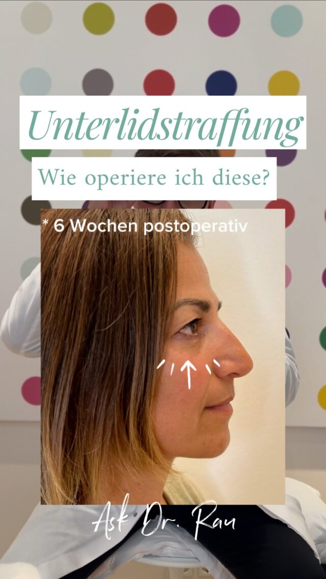 Tränensäcke effektiv behandeln - mit transkgajunktivaler Fettkörperentfernung

Tränensäcke entstehen oft durch das Vorwölben von Fettkörper im Unterlidbereich. Diese Fettpolster können mit zunehmendem Alter oder aufgrund genetischer Faktoren deutlich sichtbarer werden und ein müdes und abgespanntes Aussehen verleihen.

Die transkonjunktivale Fettkörperentfernung ist eine minimalinvasive Behandlung, die direkt durch die Bindehaut (Konjunktiva) des Augenlids erfolgt - also ohne sichtbare Hautschnitte. Dadurch bleibt die Haut rund um die Augen intakt und es entstehen keine sichtbaren Narben.
Vorteile der transkonjunktivalen Methode:
��Präzise Fettentfernung für eine gezielte Verbesserung der Augenpartie
��Minimal inyasive Technik mit schneller Heilung und kaum sichtbaren Narben
��Natürliche Ergebnisse ohne Hautschnitte oder äußere Narben
Nach der Behandlung wirkt die Augenpartie frischer, die Tränensäcke werden reduziert und das gesamte Erscheinungsbild wirkt verjüngt.

Du bist interessiert an einer Behandlung?
Lass Dich individuell beraten und erfahre, wie ich mit dieser innovativen Technik Deine Augenpartie verjüngen kann. Vereinbare noch heute einen Termin!

https://www.doctolib.de/einzelpraxis/hamburg/dr-armin-rau-plastische-chirurgie-hamburg/booking/motives?specialityld=1297&telehealth=false&placeld-practice-364896&bookingFunnelSource=deep_link

oder telefonisch unter
040 4606 3344

Herzlichst, Euer Dr. Armin Rau

#drarminrau #plastischerchirurg #medicalbeautyhamburg #lidstraffung #oberlidstraffung #unterlidstraffung