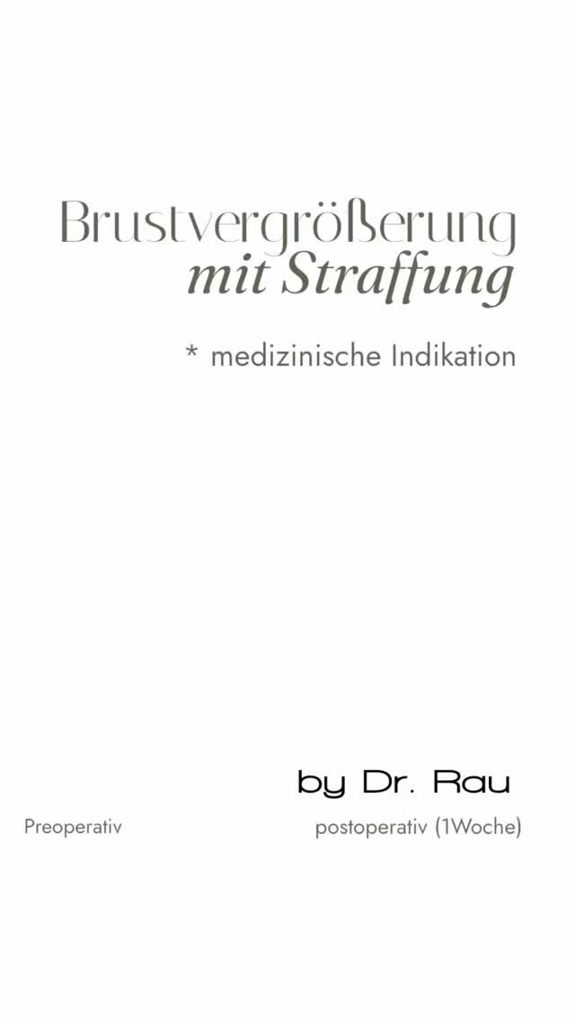 Brustrekonstruktion bei Anisomastie

Jede Brust ist einzigartig - und manchmal auch unterschiedlich. Für viele Frauen kann eine ausgeprägte Asymmetrie jedoch belastend
sein, so dass der Wunsch nach einer angleichenden Operation besteht.

Die operative Korrektur einer Volumen- und Formasymmetrie ist ein anspruchsvoller Eingriff in der ästhetischen Chirurgie. Diese erfordert eine präzise Planung und ein feines Gespür für Proportionen und Ästhetik.

Zunächst wird die Volumendifferenz genau analysiert, um individuell passende Implantate auszuwählen. Anschließend wird die Form angeglichen - etwa durch eine Straffung der größeren, hängenden Brust, sodass diese harmonisch an die kleinere Seite anpasst werden kann. 

Auch die Hautbeschaffenheit und spätere Veränderungen im Heilungsprozess werden dabei vorausschauend berücksichtigt.

Da der Körper sich während der Heilung verändert, wird darauf bereits bei der Operation geachtet, um ein langfristig schönes harmonisches Ergebnis zu erzielen.

Umso mehr freut es mich, dass sich meine Patientin bereits zwei Wochen nach dem Eingriff wieder wohl in ihrem Körper fühlt.

Danke für Ihr Vertrauen!

Dr. Armin Rau 

#medicalbeautyhamburg #lidstraffung #schönheitschirurgie #hamburg #plastischechirurgiehamburg
