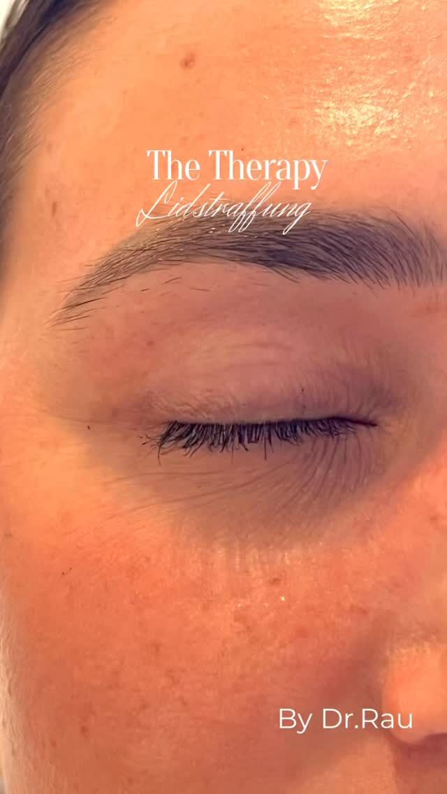 OBERLIDSTRAFFUNG- Individualisierte & personalisierte Oberlidstraffung - upper eyelid lift custom made

So einzigartig wie meine Patienten sind, ist auch ihr jeweiliger Befund.

Die Kunst für ein perfektes Ergebnis bei einer Oberlidstraffung beginnt bei der Planung. Diese muss im Sitzen erfolgen, damit meine Patienten nach der Operation die Augen noch vollständig schließen können, aber im geschlossenen Zustand kein Hautüberschuss mehr besteht.

Ich lege zudem großen Wert auf eine optimale Blutstillung. Dadurch haben meine Patienten meist kein Hämatom - es entstehen keine Pandabär-Augen.

Wegen meiner nahezu 33-jährigen chirurgischen Erfahrung und über 30.000 Operationen besteht besonders im Bereich der Lidstraffungen eine besondere Sicherheit.

Je länger eine Wunde „offen“ ist, umsomehr Entzündungsmediatoren werden freigesetzt. Durch die kurze Op-Zeit von etwa 20 Minuten entsteht anschließend meist auch eine lediglich geringe Schwellung.

Meine Patienten berichten überwiegend, dass sie keinerlei Schmerzen verspürt haben - weder im Rahmen der Operation, noch danach.

Die Oberlidstraffung verbindet sowohl ästhetische wie auch funktionelle Aspekte. Funktional führt der Hautüberschuss zu einem eingeschränkten Gesichtsfeld und Druck auf die Liddeckel. 

Letzteres führt häufig zu einem unbewussten Hochziehen der Augenbrauen, um die Liddeckel zu entlasten. Dies hat nicht selten Kopfschmerzen zur Folge und begünstigt die Entstehung tiefer Stirnfalten.

Kosmetisch wird durch die Oberlidstraffung die nach außen ansteigende Augenachse wird wieder sichtbar und der Blick dadurch wacher. Zudem entspannt sich die Stirn auch wieder. Stirnfalten reduzieren sich.

Für eine persönliche Beratung könnt Ihr gerne einen Termin über den online Terminkalender vereinbaren oder telefonisch Mo-Fr 10-18h unter 040 4606 3344

Herzlichst, Euer Dr. Armin Rau

#lidstraffung #hamburg #oberlidstraffung