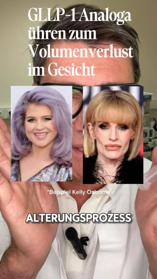 Gesichtsvolumenaufbau nach Wegovy &Co. 

Eine große Herausforderung in der Plastischen & Ästhetischen Chirurgie stellt der ausgeprägte Volumenverlust im Gesicht durch Abnehmspritzen (GLP-1-Analoga) dar.

Die bioregereative Methode mit Stammzellen-reichem autologem (körpereigenem) lipomatösem Gewebe entwickelt sich hierbei derzeit zum Goldstandard beim Lösen derartiger Veränderungen.

Die wesentlichen Vorteile gegenüber herkömmlichen Fillern wie Hyaluronsäure, Milchsäure (z. B. Sculptra) oder Hydroxylapatit (z. B. Radiesse) sind:

Natürliche und harmonische Ergebnisse - da ausschließlich körpereigenes Material verwendet wird, fügt sich das Gewebe „nahtlos“ in die individuelle Gesichtsanatomie ein.

Ganzheitliche Geweberegeneration - neben dem ursprünglichen ortsspezifischen Kollagen werden Elastin, körpereigene Hyaluronsäure und extrazelluläre Matrix erneuert.

Langanhaltende Wirkung - im Gegensatz zu Fillern, die abgebaut werden zeigen die bio-regenerativen Verfahren nachhaltige und vor allem effektive Ergebnisse 

Keine Fremdkörperreaktion - das Risiko für allergische Reaktionen oder Abstossungsreaktionen entfällt 

Gerne berate ich Euch persönlich. Einen Termin für eine Beratung könnt ihr über den Online Terminkalender vereinbaren oder telefonisch unter 040 46063344

Euer Dr. Armin Rau

#drarminrau #lidstraffung #hamburg #oberlidstraffung #plastischechirurgiehamburg