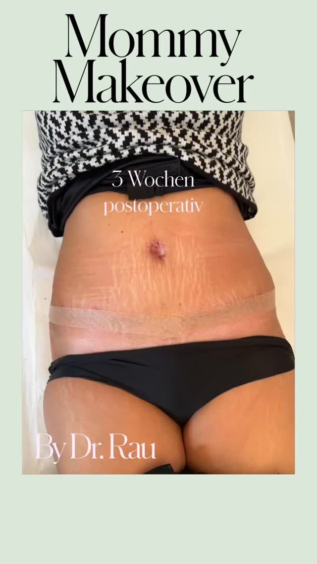 Bauchstraffung by Dr. Armin Rau - Plastische
Chirurgie Hamburg 

Erfahrung, die zählt:
��Uber 1.500 Bauchdeckenplastiken durchgeführt
��Mehr als 10 Jahre Kooperationspartner des Adipositaszentrum Nord
��Spezialisiert als DIEP-Operateur - Bauchstraffung ist hierbei kosmetischer Nebeneffekt
Präzision trifft Effizienz:
��Kurze OP-Dauer = kürzere Narkosezeit
��Ambulante Versorgung möglich - kein langer
Klinikaufenthalt nötig
Schonender Eingriff:

• Reiner Weichteileingriff - geringer
Schmerzmittelbedarf

Sanfte Heilung, schnelle Erholung

Schnell zurück im Alltag:
��Bürotätigkeit: 5-7 Tage bis zur Arbeitsfähigkeit
��Körperliche Tätigkeit: 2-3 Wochen Erholungszeit
Beratungstermin vereinbaren: 040 46063344

#Bauchstraffung #PlastischeChirurgie #DrArminRau #Hamburg #Schönheitschirurgie Bauchdeckenplastik
AmbulantOP Körpergefühl BeautyGoals
SelbstbewusstSein Bauchstraffung