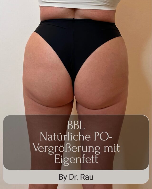 Brazilian Butt Lift (BBL) – Natürlich schöne Konturen mit Eigenfett 🍑

Das Brazilian Butt Lift (BBL) kombiniert eine Fettabsaugung mit einer Eigenfetttransplantation, um das Gesäß auf natürliche Weise zu formen und gleichzeitig die Körperkonturen zu optimieren.

Im Gegensatz zu Implantaten wird ausschließlich körpereigenes Fett verwendet. Das Ergebnis fühlt sich natürlich an, integriert sich harmonisch ins Gewebe und kann nach erfolgreicher Einheilung viele Jahre erhalten bleiben.

Entscheidend für ein sicheres und ästhetisches Ergebnis sind eine sorgfältige Patientenauswahl, eine schonende Fettaufbereitung sowie die Einhaltung moderner Sicherheitsstandards bei der Fetttransplantation.

Ein gelungenes Brazilian Butt Lift bedeutet nicht nur mehr Volumen – sondern vor allem harmonische Proportionen und ein natürliches Körperbild.

Euer Dr. Armin Rau

www.dr-armin-rau.de

#BrazilianButtLift #BBL #Eigenfett #Fetttransfer #BodyContouring Liposuktion PoVergrößerung NatürlicheErgebnisse ÄsthetischeChirurgie PlasticSurgery