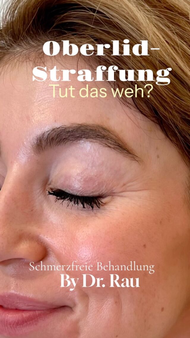 Tut eine Oberlidstraffung weh?
Die kurze Antwort: Nein – während der eigentlichen Operation verspüren meine Patientinnen und Patienten keinen Schmerz.
Die meisten meiner Patientinnen und Patienten haben Angst vor Schmerzen im Rahmen einer Oberlidstraffung.
 
Doch wie läuft diese genau ab?
Diese beginnt zunächst mit dem „Dämmerschlaf“
Bevor die örtliche Betäubung im empfindlichen Augenbereich injiziert wird, verabreiche ich intravenös 5 mg Midazolam. Sobald der Dämmerschlaf anflutet, schlafen die Patientinnen und Patienten kurz ein, sind tief entspannt und nehmen den Pikser der örtlichen Betäubung in der Regel gar nicht wahr.
Ab dem Moment, in dem die Lokalanästhesie wirkt, ist der Operationsbereich schmerzfrei.
Anschließend wird der zuvor präzise vermessene und individuell bestimmte Hautüberschuss am Oberlid umschnitten und entfernt.
Dabei lege ich besonderen Wert auf eine subtile Blutstillung. Dadurch entstehen nach der Operation meist überhaupt keine oder nur sehr geringe Blutergüsse, ohne dass „Pandaaugen“ entstehen.

Und nach der Operation?
Direkt nach dem Eingriff erhalten meine Patientinnen und Patienten noch eine Schmerztablette. Meist werden bereits ab dem ersten Tag nach der Operation keine Schmerzmittel mehr benötigt.
Mein Ziel bei jeder Oberlidstraffung:
präzises Arbeiten, möglichst wenig Gewebetrauma, eine subtile Blutstillung und eine schnelle, möglichst angenehme Erholung.
Wenn Sie über eine Oberlidstraffung nachdenken und wissen möchten, wie der Eingriff konkret abläuft, sprechen Sie mich gerne an.#
Einen Termin für eine Beratung können Sie über den online Terminkalender vereinbaren:
https://www.doctolib.de/einzelpraxis/hamburg/dr-armin-rau-plastische-chirurgie-hamburg/booking/motives?telehealth=false&specialityId=1297&placeId=practice-364896&pid=practice-364896&source=deep_link&speciality_ids%5B%5D=1297
oder telefonisch Mo-Fr 10-18h unter
040 4606 3344
Euer Dr. med. Armin Rau
 
 
#Oberlidstraffung #Lidstraffung #Blepharoplastik #lidstraffung