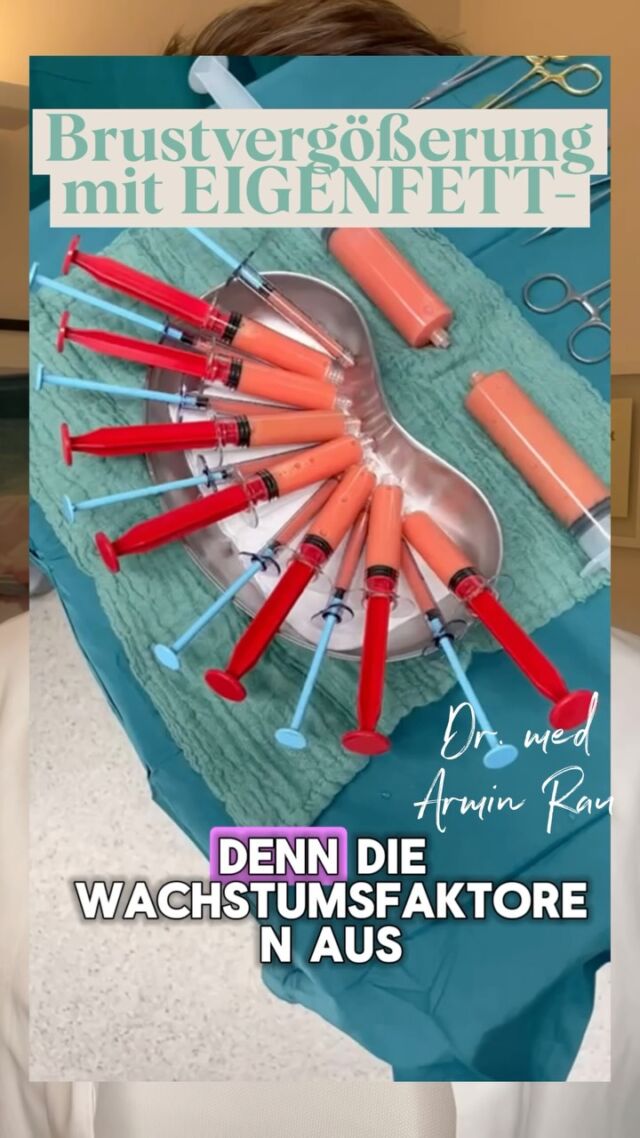 Dualevel+technique - Brustvergrößerung mit autologem Eigenfett für ein natürliches Ergebnis

präzise Verteilung in zwei Logen vor und hinter der Brustdrüse
größere Volumina (ca. 500ml/pro Seite) werden gleichmäßig eingebracht
Wachstumsfaktoren aus ergänztem PRP erhöhen zusätzlich die Einheilrate
bei meinen Patientinnen heilen regelhaft ca. 60% dauerhaft ein

Terminvereinbarung über:

https://www.doctolib.de/einzelpraxis/hamburg/dr-armin-rau-plastische-chirurgie-hamburg/booking/motives?telehealth=false&specialityId=1297&placeId=practice-364896&pid=practice-364896&source=deep_link&speciality_ids%5B%5D=1297

oder telefonisch unter

+49 40 4606 3344
Euer Dr. Med Armin Rau

#DualevelPlus #Brustvergrößerung # BrustvergrößerungMitEigenfett #EigenfettBrust #Lipofilling BrustLipofilling AutologesFett PRP PlättchenreichesPlasma Eigenfetttransfer Brustchirurgie PlastischeChirurgie ÄsthetischeChirurgie NatürlicheBrustvergrößerung NaturalBreastAugmentation