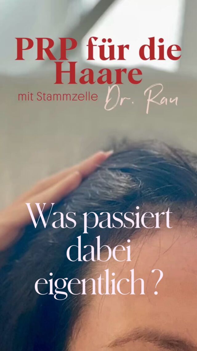 Was ist PRP? Wie kann es beim Haarwachstum helfen?
Platelet-Rich Plasma = plättchenreiches Plasma aus dem eigenen Blut

Die Blutplättchen enthalten zahlreiche Wachstumsfaktoren, die an Regenerationsprozessen beteiligt sind. Bei der PRP-Behandlung wird das gewonnene Plasma gezielt in die Kopfhaut eingebracht.

PRP für die Haare

Haarausfall kann viele Ursachen haben. Eine Möglichkeit zur Unterstützung des Haarwachstums ist die Behandlung mit PRP (Platelet-Rich Plasma) – also mit dem eigenen thrombozytenreichen Plasma.

„PRP gegen Haarausfall – aber was passiert dabei eigentlich?“

kann die Haarfollikel unterstützen und stimulieren

kann die Haardichte verbessern

Kann das Haarwachstum unterstützen

körepereigenes Material = autologe Behandlung

Bei meiner Patientin ist bei der dritten Behandlung und 12 Wochen nach der ersten PRP-Behandlung schon das Wachstum von „Baby-Haar“ an der Stirn-Haar-Grenze zu sehen.

Einen Termin für eine Beratung bei Dr. med. Armin Rau in Hamburg könnt Ihr über den online Terminkalender vereinbaren:

https://www.doctolib.de/einzelpraxis/hamburg/dr-armin-rau-plastische-chirurgie-hamburg/booking/motives?telehealth=false&specialityId=1297&placeId=practice-364896&pid=practice-364896&source=deep_link&speciality_ids%5B%5D=1297

oder telefonisch Mo-Fr 10-18h unter 040 4606 3344

Euer Dr.med Armin Rau 

🩸 Blutentnahme
↓
🌀 Aufbereitung in der Zentrifuge
↓
🧬 Gewinnung des PRP / regenerativen Konzentrats
↓
💉 Aufziehen in feine Spritzen
↓
💆 Behandlung der Kopfhaut

#prp #haarausfall #drarminrau #schönheitschirurgie #haarersatz